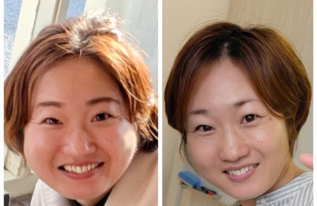 エクオによるむくみ改善で顔まわりが引き締まった変化を比べたビフォーアフター画像